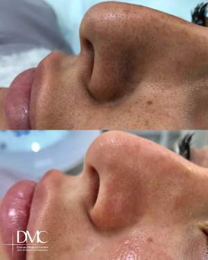 Результат вакуумной чистки лица: фото до и после