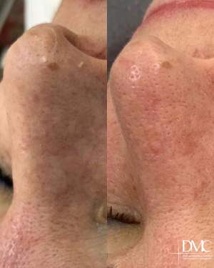 Результат вакуумной и мануальной чистки лица: фото до и после
