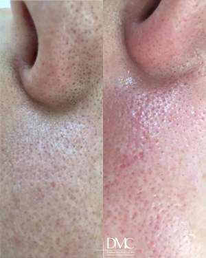 Результат вакуумной чистки кожи лица: фото до и после