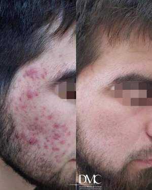 Результат лечения тяжёлой степени угревой болезни: фото до и после