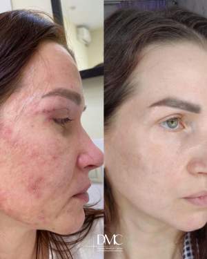 Результат промежуточного лечения кожи: фото до и после