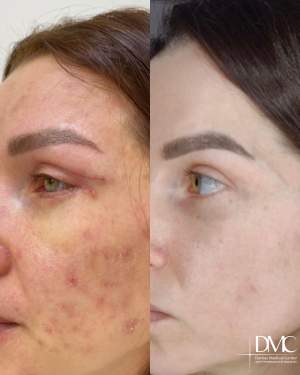 Результат промежуточного лечения кожи: фото до и после