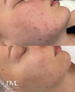 Лечение кожи лица по индивидуальному протоколу на аппарате М22