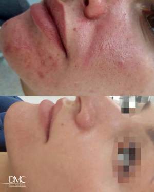 Промежуточный результат лечения акне: фото до и после