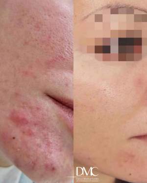 Промежуточный результат лечения акне: фото до и после