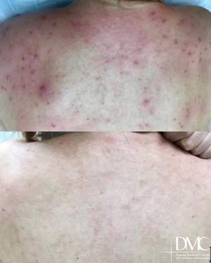 Промежуточный результат лечения воспалений спины: фото до и после