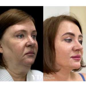 SMAS-подтяжка лица и шеи: до и после первичной реабилитации. Работа Юссефа Бассановича Дергам