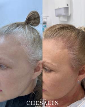 Фото до и 4 месяца после трансплантации волос в восточной лобную зону и зону постоперационных рубцов. Работа доктора Ивана Павловича Чесалина