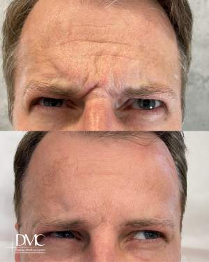 Результат коррекции морщин лба у мужчины: фото до и после