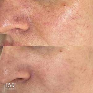 Фотоомоложение и лечение кожи на аппарате М22: удаление сосудов, улучшение качества и тургора кожи