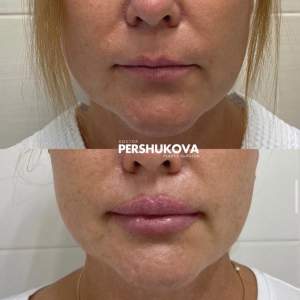 Пластика губ Кессельринг + липофилинг губ (до и после первичной реабилитации). Работа Анны Петровны Першуковой.