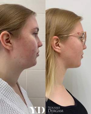 Липосакция подбородка с гравировкой нижней челюсти на аппарате Vaser: до и через месяц после операции