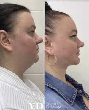 Липосакция подбородка с гравировкой нижней челюсти на аппарате Vaser: до и через месяц после операции
