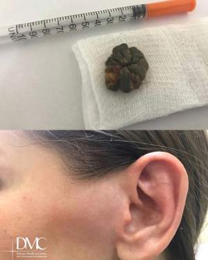 Результат лазерного удаления папилломатозного невуса: фото до и после полной реабилитации