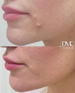 Лазерное удаление дерматологов невуса: фото до и после