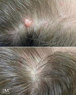 Результат лазерного удаления новообразования на волосистой части головы
