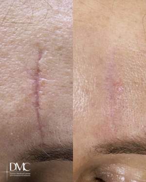 Промежуточный результат удаления глубокого шрама на лбу: фото до и после