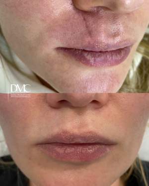 Результат лечения шрама на верхней губе методом лазерной шлифовки и коллагенотерапии препаратом «Коллост»