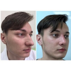 Фото результатов мужской пластики носа: до и после