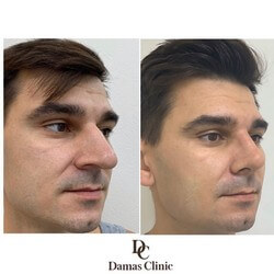 Фото результатов мужской пластики носа: до и после
