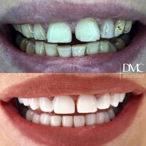 Керамические виниры до и после установки в стоматологическом отделении Damas Medical Center