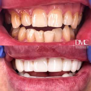 Композитные виниры до и после установки в стоматологическом отделении Damas Medical Center