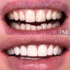Композитные виниры до и после установки в стоматологическом отделении Damas Medical Center
