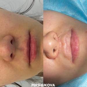 Комплексная пластика губ Булхорн + липофилинг губ (нижняя и верхняя) + липофилинг губ (увеличение жировой тканью) + V-Y пластика губ (до и сразу после операции). Работа Анны Петровны Першуковой.