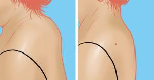 Тыльная поверхность шеи до и после операции