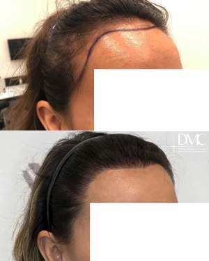 Женская пересадка волос в височно-лобную зону с формированием новой линии роста волос. до и через 14 месяцев после. Работа доктора Альбины Дахировны Тебуевой
