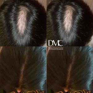Пересадка в зону рубцовой ткани на голове: до и через 1,5 года после в отзыве от пациента. Работа доктора Альбины Дахировны Тебуевой