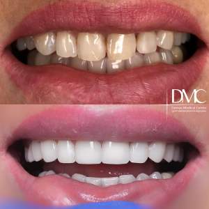 Керамические виниры до и после установки в стоматологическом отделении Damas Medical Center