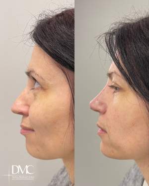 Коррекция формы носа филлером: до и после