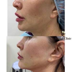 Лифтинг лица хирургическими нитями: до и после процедуры