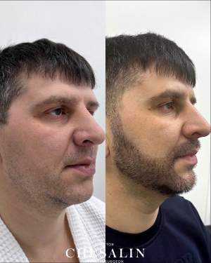 Результат пересадки бороды: фото до и 2 недели после. Работа доктора Ивана Павловича Чесалина
