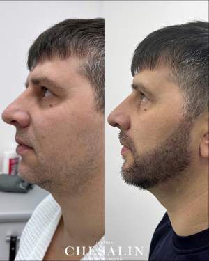 Результат пересадки бороды: фото до и 2 недели после. Работа доктора Ивана Павловича Чесалина
