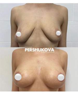 Подтяжка груди по ареоле с имплантами: до и в период реабилитации. Работа Анны Петровны Першуковой