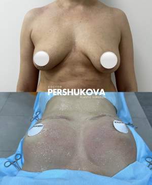 Подтяжка груди + липофилинг: до и сразу после. Работа Анны Петровны Першуковой
