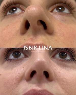 Пластика носа: до и после. Работа Лины Алиевны Исбир