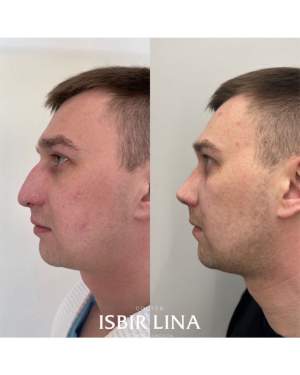 Мужская пластика носа: до и через 1 месяц. Работа Лины Алиевны Исбир