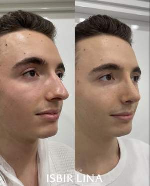 Мужская пластика носа с восстановлением дыхания: до и через 10 суток. Работа Лины Алиевны Исбир