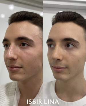 Мужская пластика носа с восстановлением дыхания: до и через 10 суток. Работа Лины Алиевны Исбир