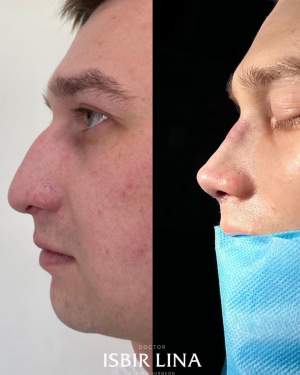 Мужская пластика носа: до и сразу после. Работа Лины Алиевны Исбир