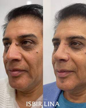 Реконструкция с восстановлением дыхания и всей структуры носа: до и через 10 суток. Работа Лины Алиевны Исбир