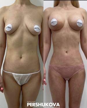 Комплексная липоскульптура тела + увеличение груди имплантами: до и после. Работа Анны Петровны Першуковой