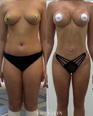 Комплексная липоскульптура тела + увеличение груди имплантами: до и после. Работа Ивана Павловича Чесалина