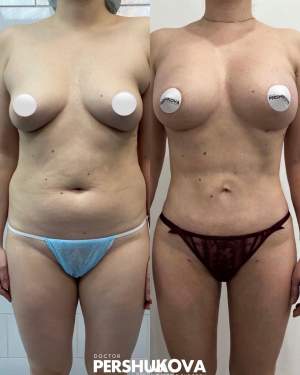 Липоскульптура тела с липосакцией всех проблемных зон + липофилинг груди: до и после первичной реабилитации. Работа доктора Анны Петровны Першуковой