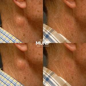 Удаление липомы на шее: до и после полной реабилитации. Работа пластического хирурга - доктора Мунифа Хальдун