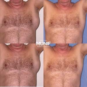 Удаление большой липомы в области груди: до и после полной реабилитации на плановом осмотре