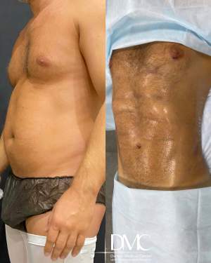 Мужская липоскульптура с липосакцией всех проблемных зон с тщательной прорисовкой мышечного рисунка пресса и груди сразу после операции